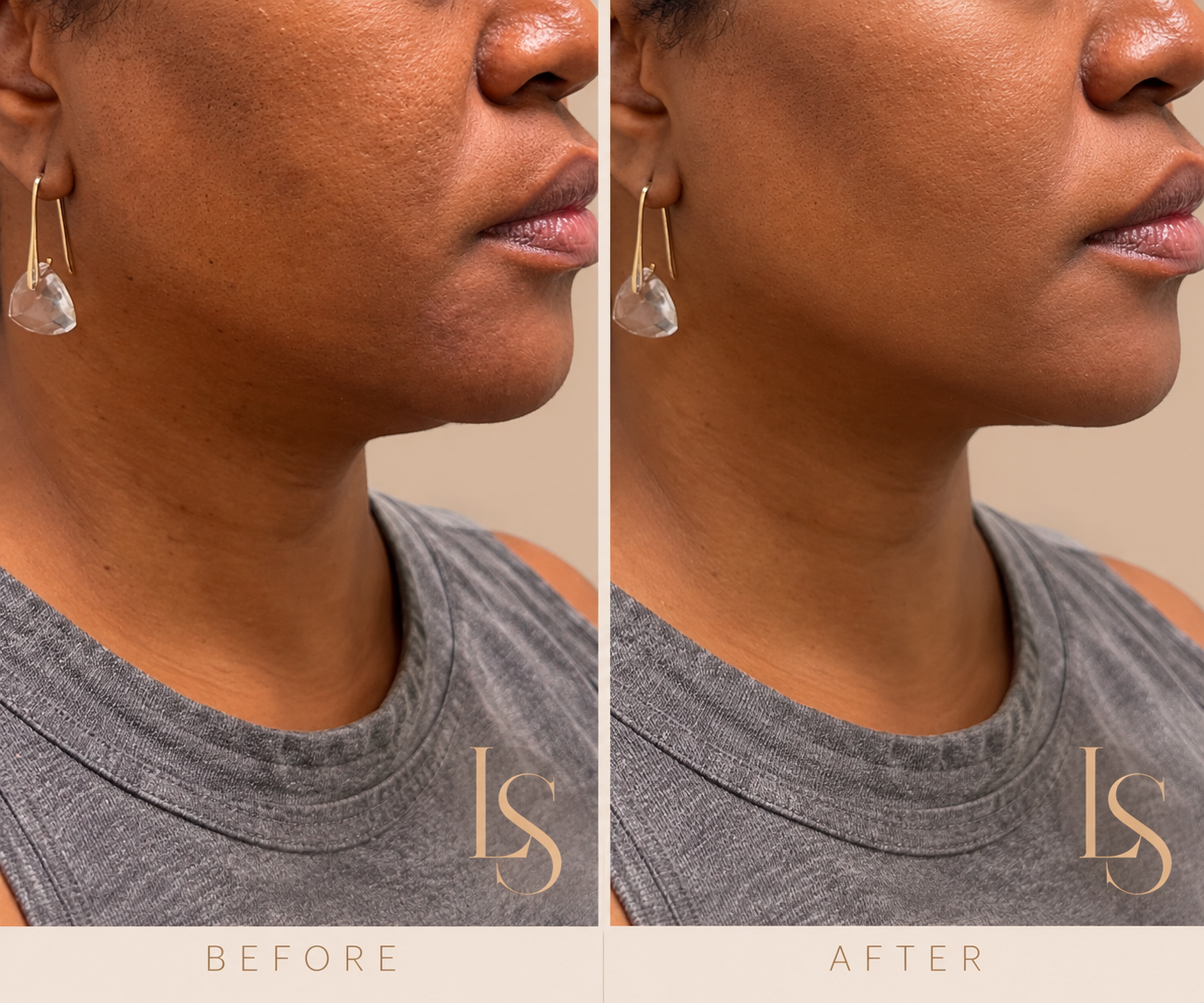 Before and after: jawline filler, side profile view of the jaw and chin