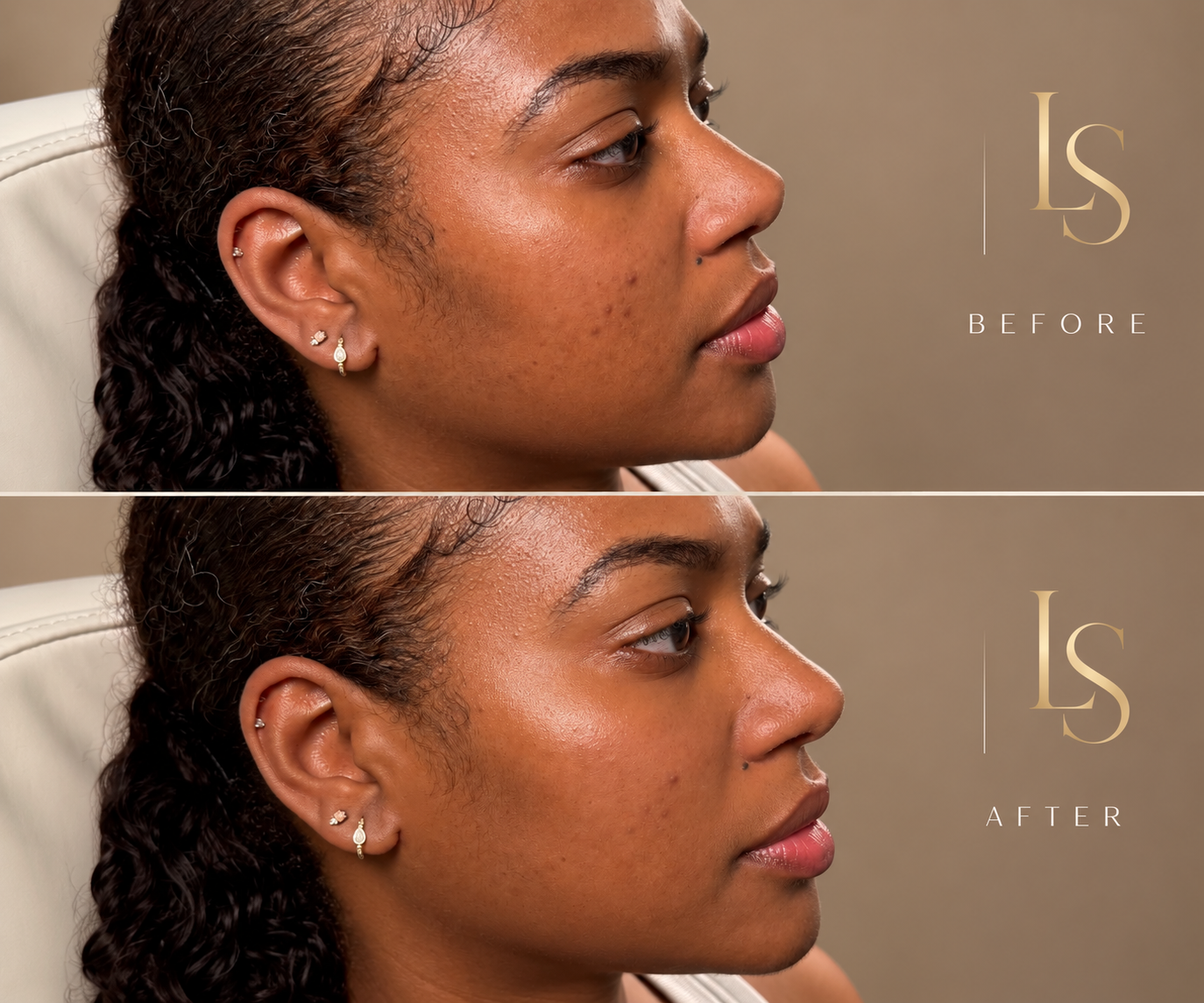 Before and after: jawline filler, profile view showing a more defined jawline