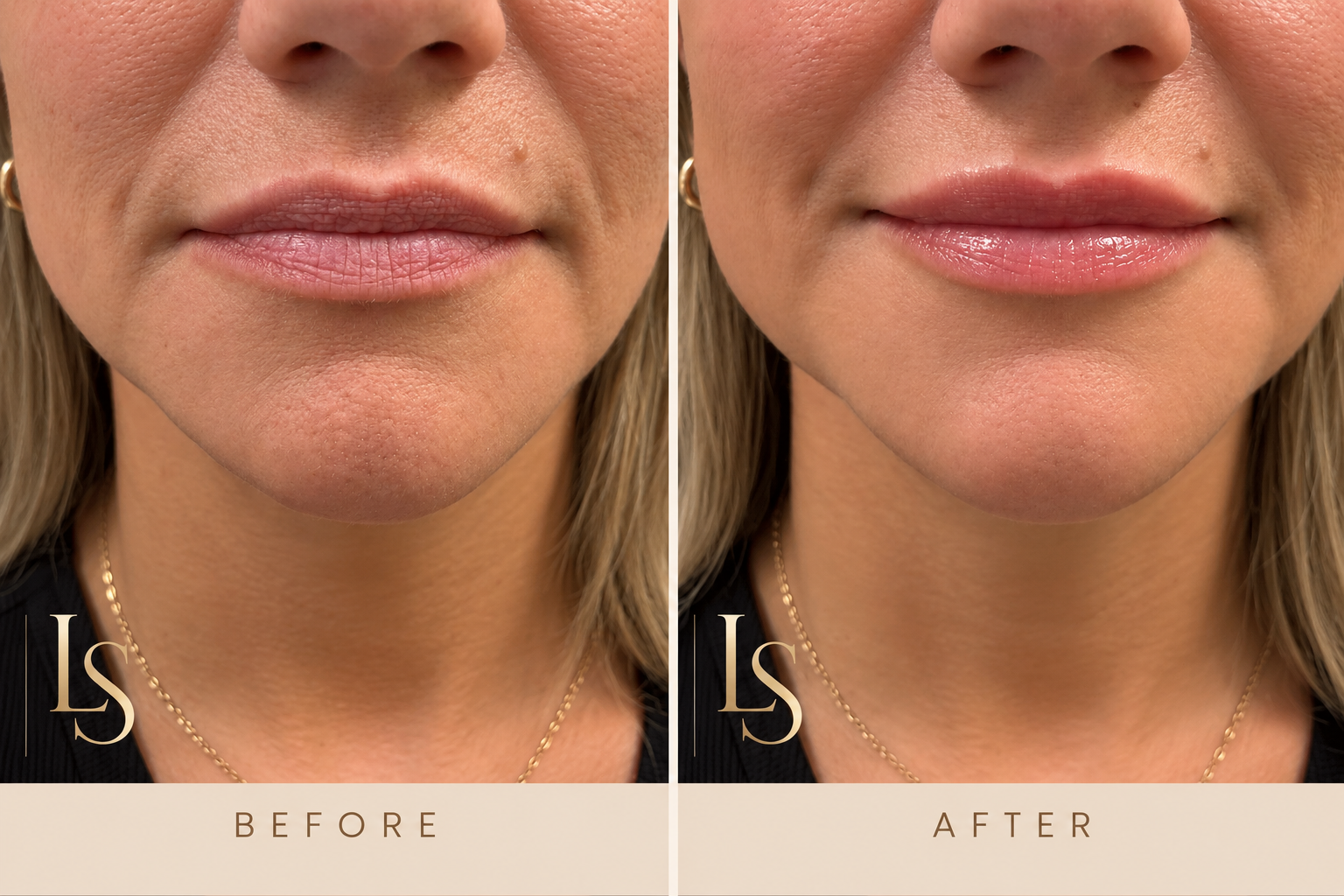 Before and after: lip filler, front view of the lips and lower face