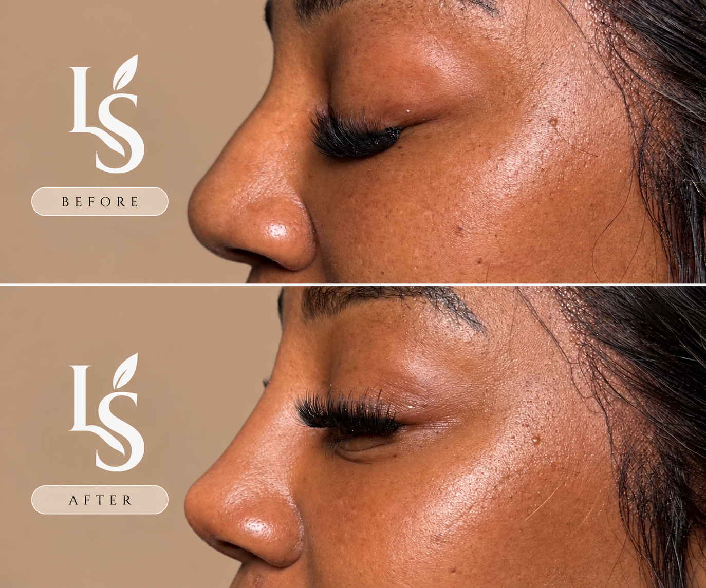 Before and after: non-surgical rhinoplasty with filler, side profile of the nose