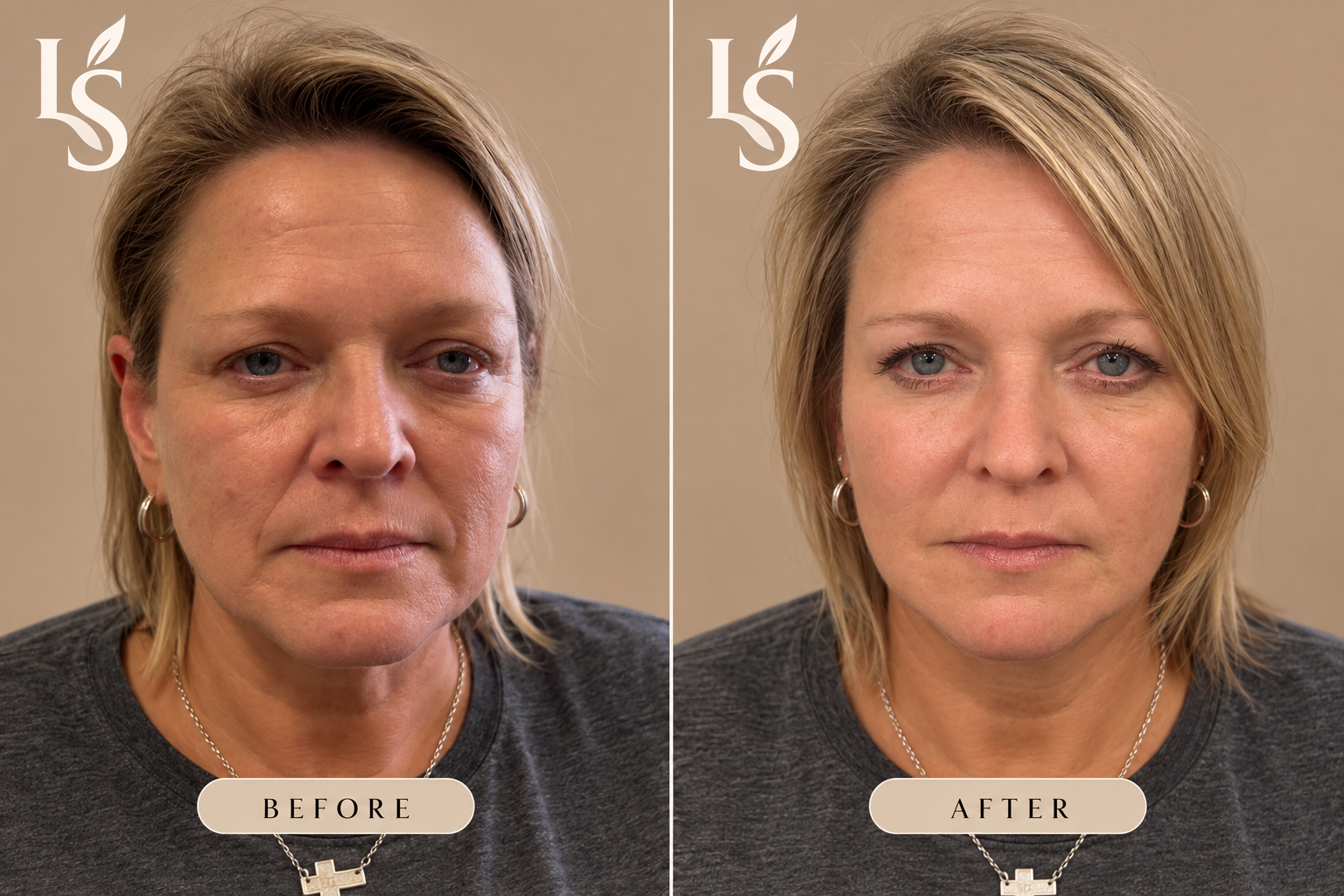 Before and after: full-face facial balancing with filler, front view