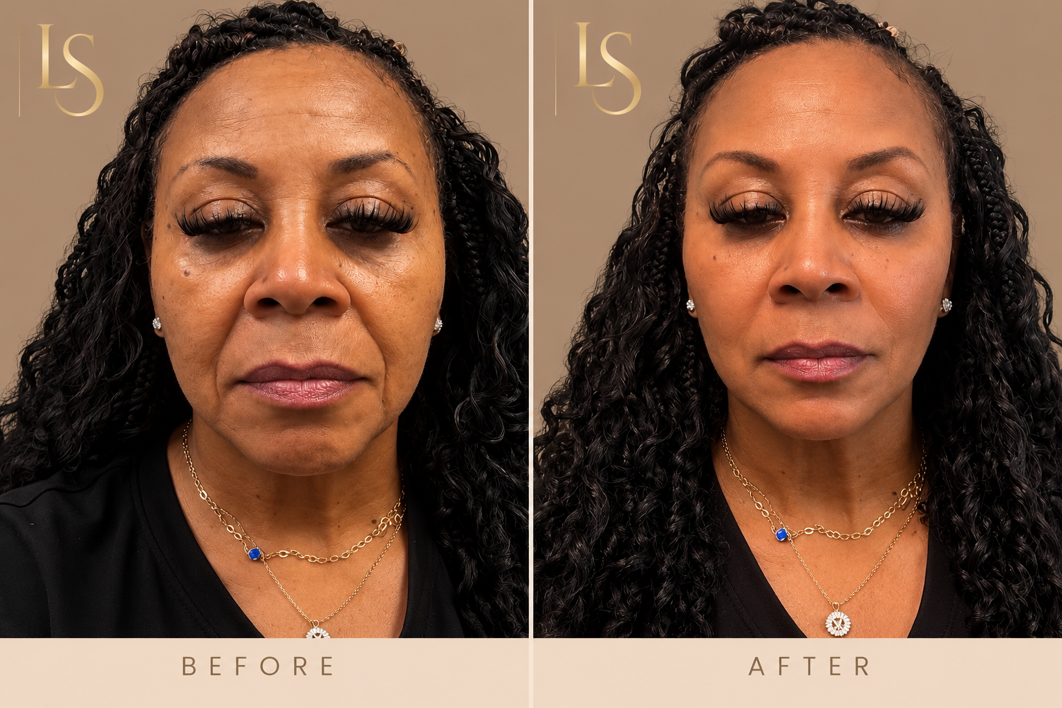 Before and after: full-face facial balancing with filler, front view