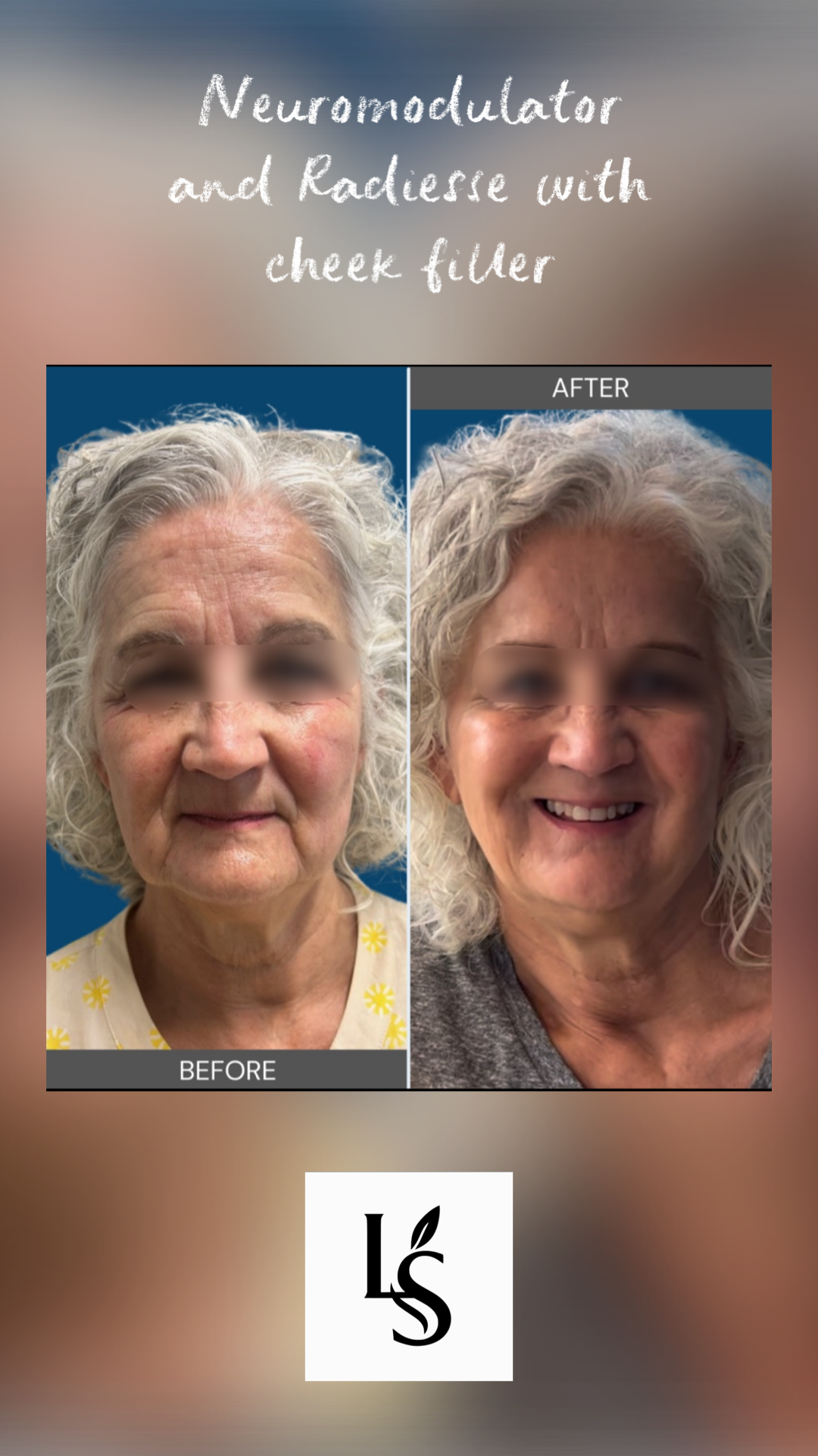 Before and after: neuromodulator and Radiesse with cheek filler at Le Skin Aesthetics