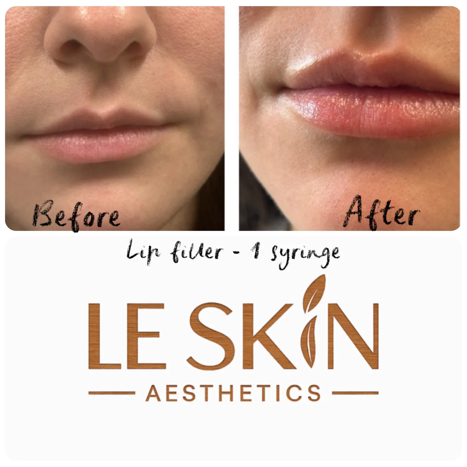 Before and after: lip filler, one syringe, at Le Skin Aesthetics
