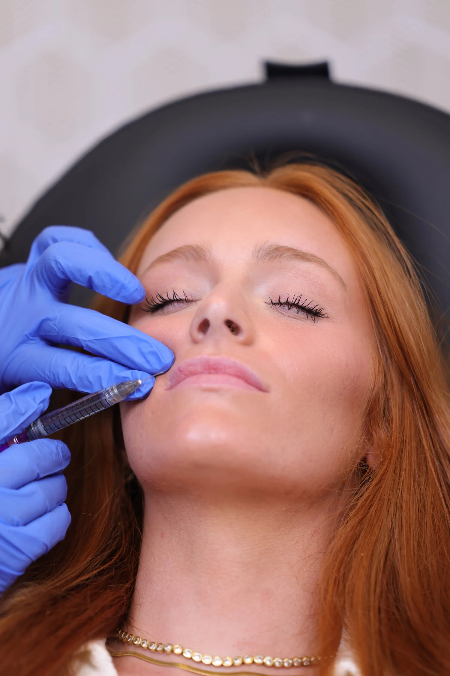Cosmetic injection in the upper lip