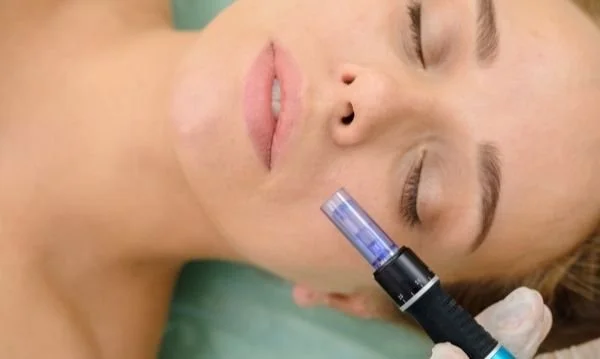 Microneedling device on a woman’s cheek
