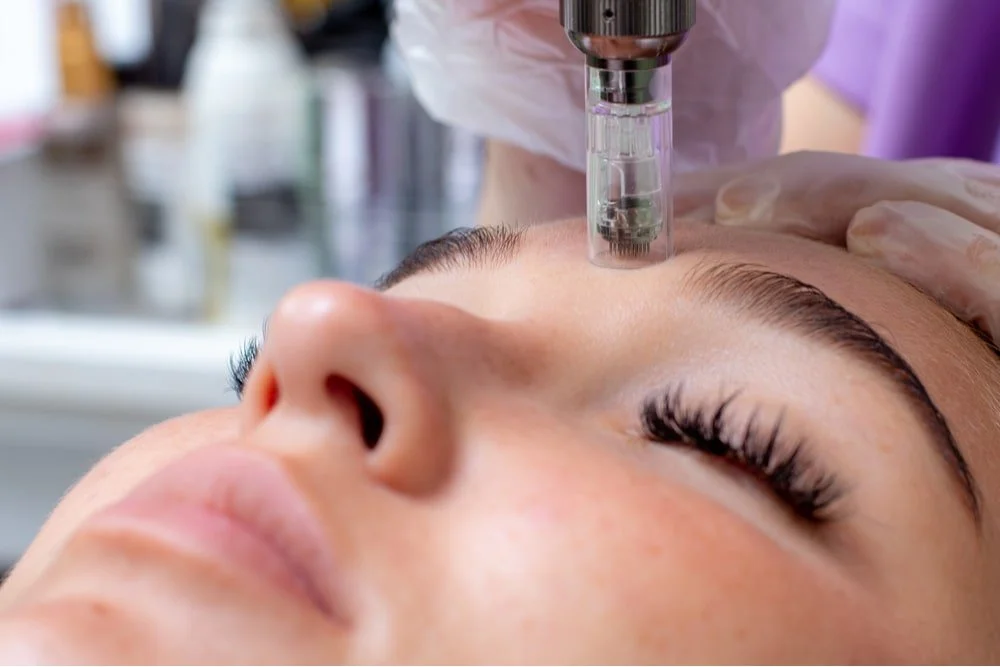 A woman receiving a microneedling treatment on her forehead