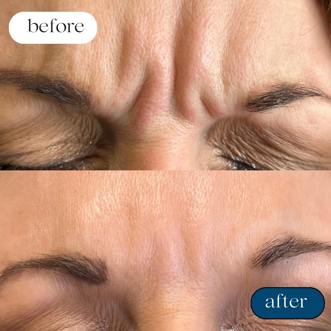 Before and after: frown lines smoothed with a neuromodulator