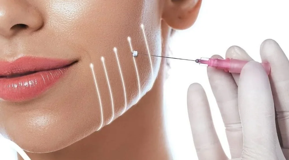 Illustration of lifting lines on a woman’s cheek