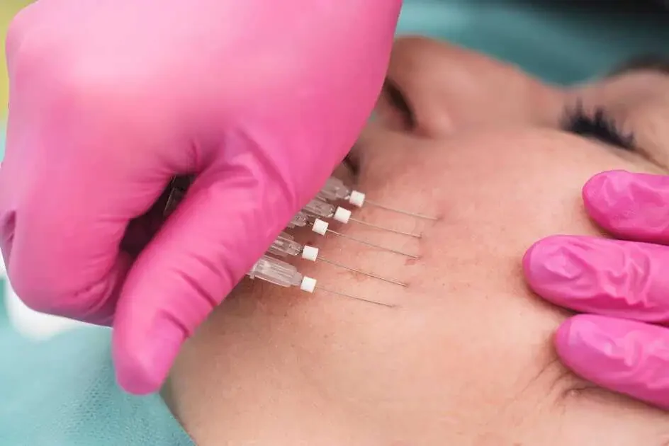 PDO threads being placed along the jawline