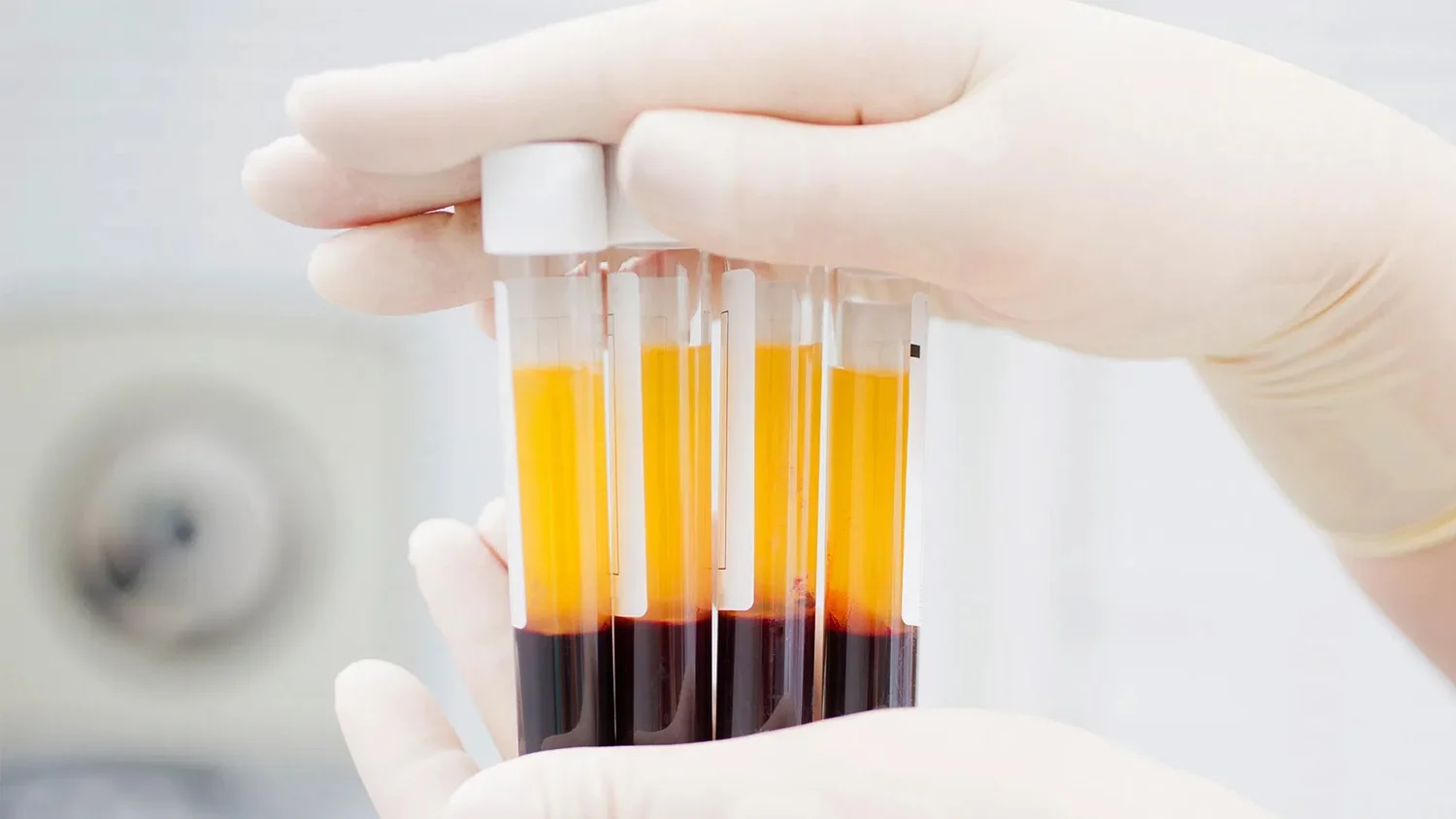 Tubes of platelet-rich fibrin held by a gloved hand