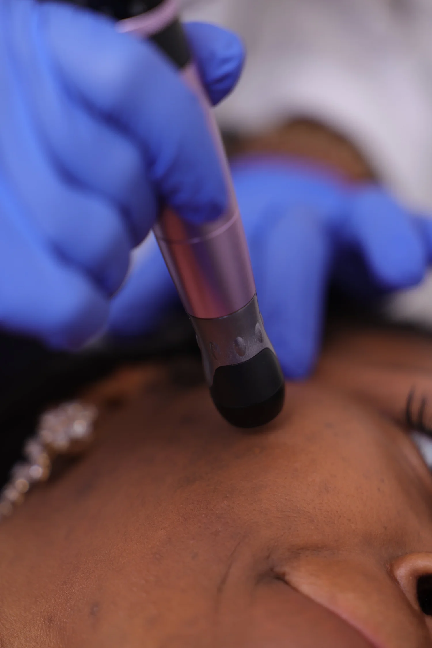 Close-up of a person receiving a cosmetic treatment with a device on their forehead